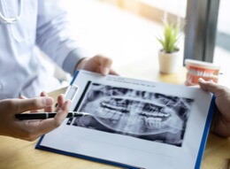 Partial Dentures