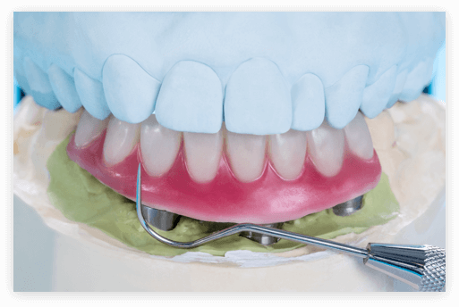 Implant Over Denture implant over denture