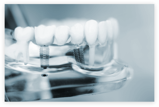 Dental Implants Model clear plastic model of dental implants