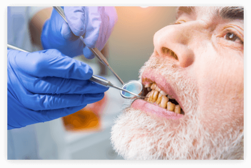 Decaying Teeth elderly main with stained and decaying teeth being checked by a denturist