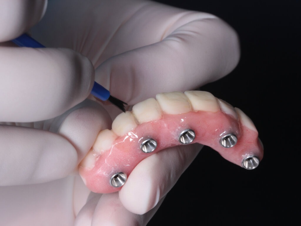 implant supported dentures
